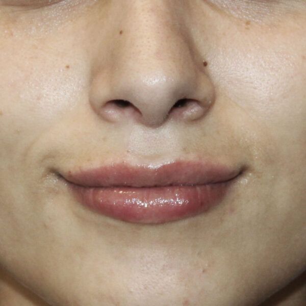 Filler - Efter