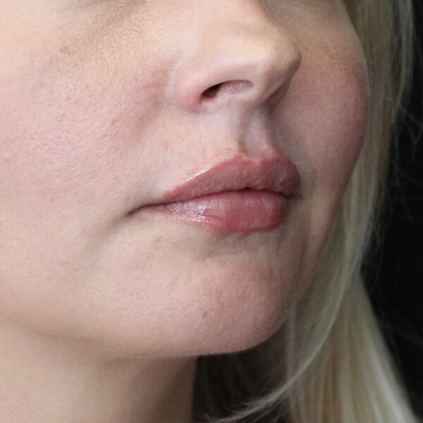 Filler - Efter